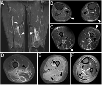 Increased expression of cell adhesion molecules in myofasciitis